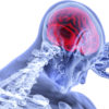 Ataxia | Ortopedia Queraltó
